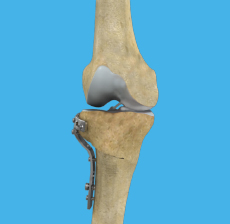 high-tibial-osteotomy.jpg